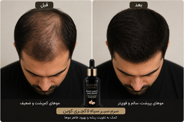 سرم سیر سیاه لاکچری کوین | سرم تقویتکننده مو، ریش و سبیل