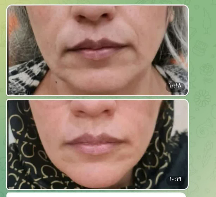 خرید کرم لیفتینگ و ضدچروک لاکچری کوین | کرم سفت کننده بیوممتیک با ماساژور ۱۲۰ میل