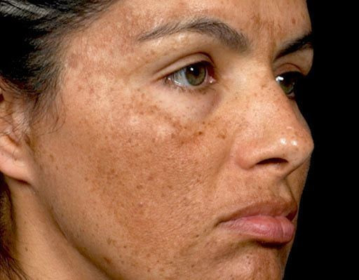 ✨ سرم ضدلک لاکچری کوین حاوی ویتامین A و C | روشنکننده و شفافکننده پوست