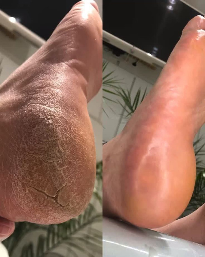 🔥 کرم پا ویتابلا؛ خداحافظی با خشکی و زبری و ترک پا! 👣