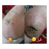 🔥 کرم پا ویتابلا؛ خداحافظی با خشکی و زبری و ترک پا! 👣