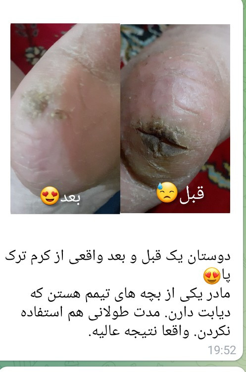 🔥 کرم پا ویتابلا؛ خداحافظی با خشکی و زبری و ترک پا! 👣